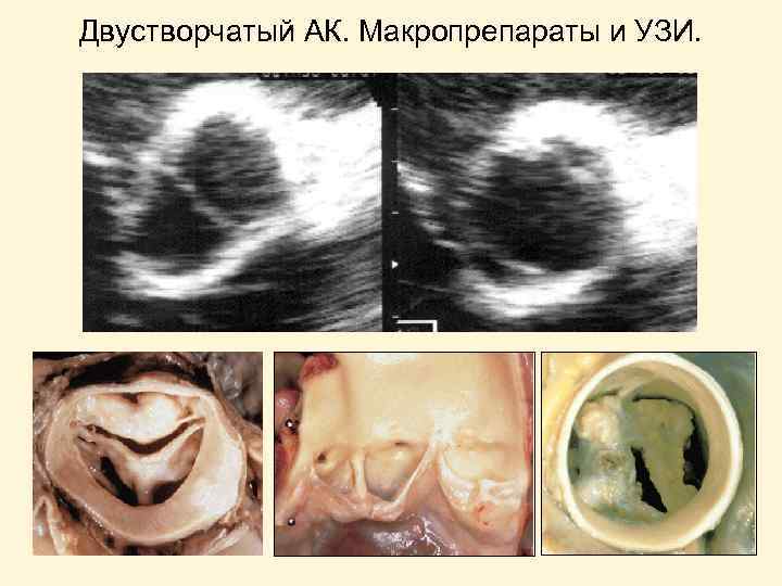 Двустворчатый АК. Макропрепараты и УЗИ. закрытие открытие 