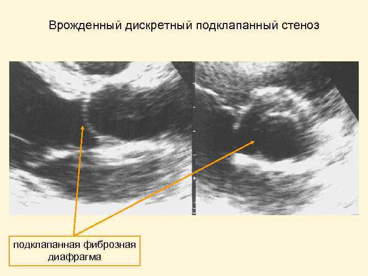 Врожденный дискретный подклапанный стеноз подклапанная фиброзная диафрагма 
