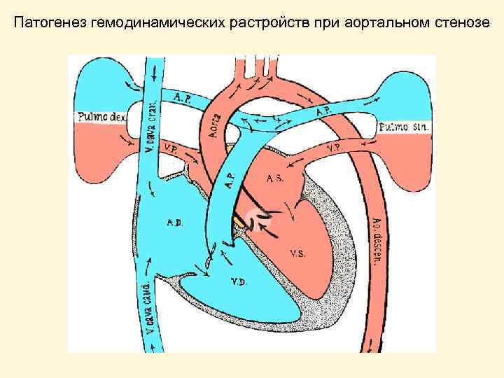 Патогенез гемодинамических растройств при аортальном стенозе 
