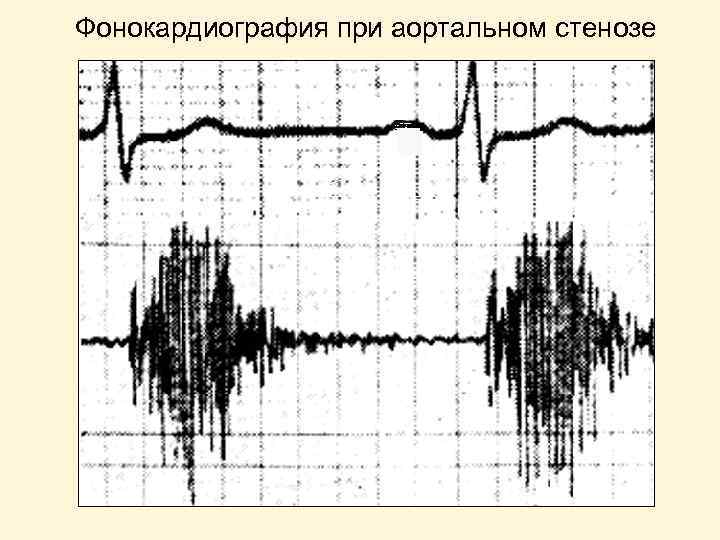 Фонокардиография при аортальном стенозе 