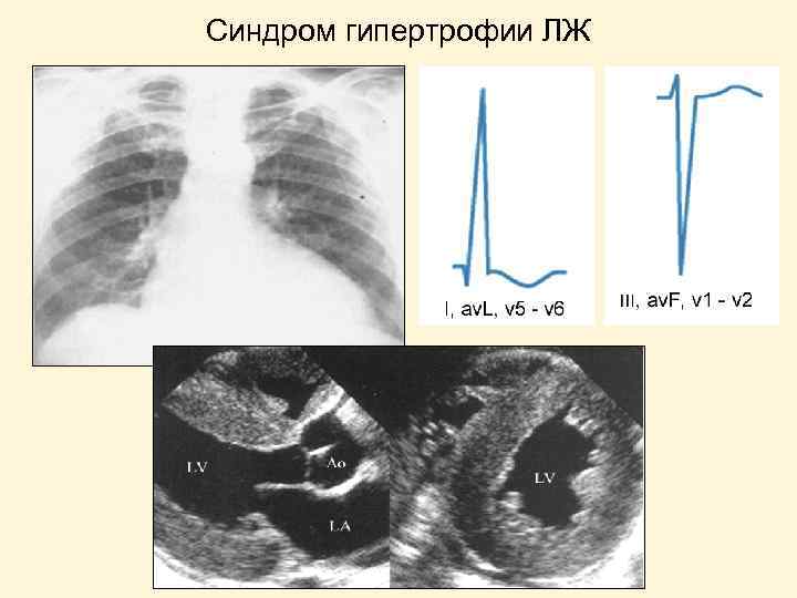 Синдром гипертрофии ЛЖ 