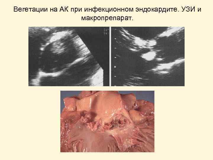 Вегетации на АК при инфекционном эндокардите. УЗИ и макропрепарат. 
