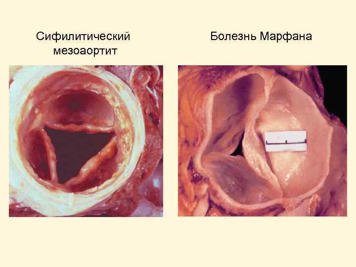 Сифилитический мезоаортит Болезнь Марфана 