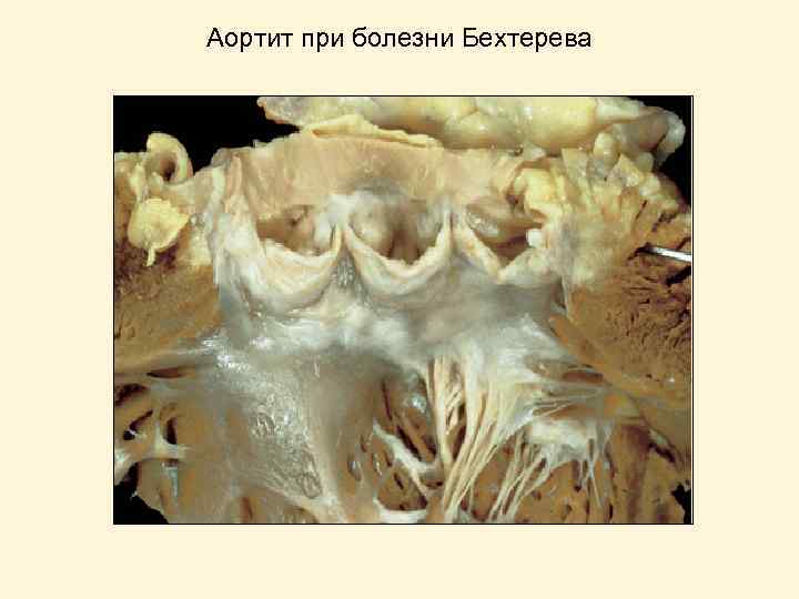 Аортит при болезни Бехтерева 