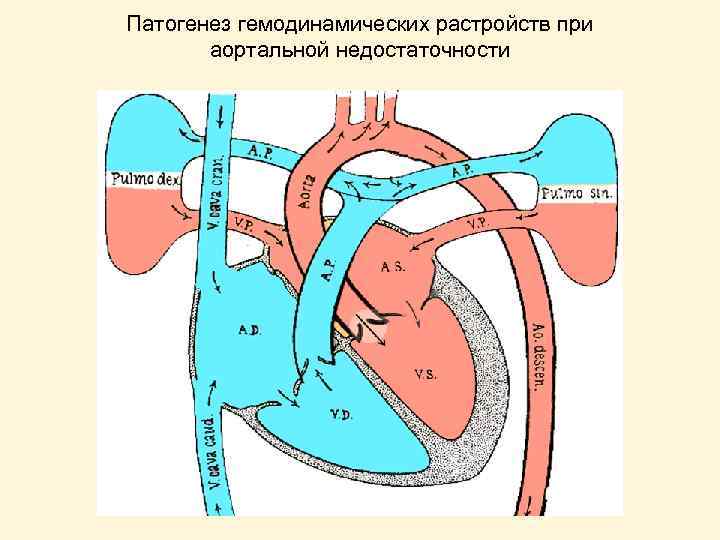 Патогенез гемодинамических растройств при аортальной недостаточности 