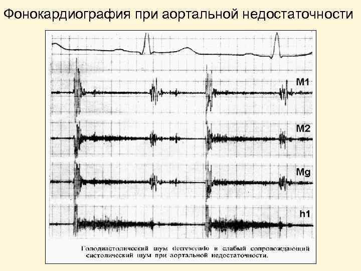 Фонокардиография при аортальной недостаточности 