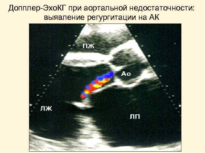 Допплер-Эхо. КГ при аортальной недостаточности: выявление регургитации на АК 