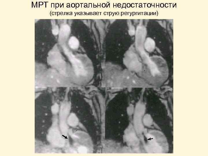 МРТ при аортальной недостаточности (стрелка указывает струю регургитации) 
