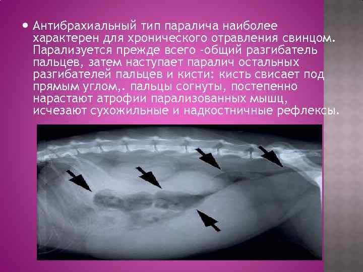  Антибрахиальный тип паралича наиболее характерен для хронического отравления свинцом. Парализуется прежде всего -общий