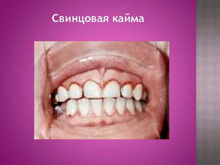 Свинцовая кайма 