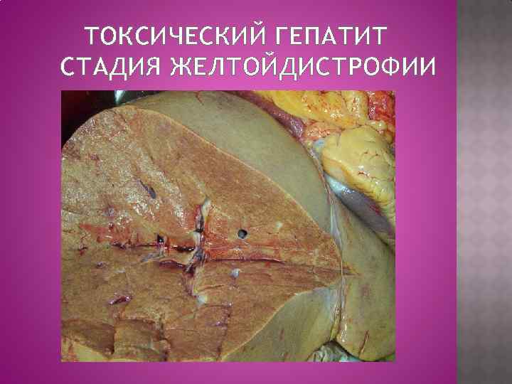 ТОКСИЧЕСКИЙ ГЕПАТИТ СТАДИЯ ЖЕЛТОЙДИСТРОФИИ 