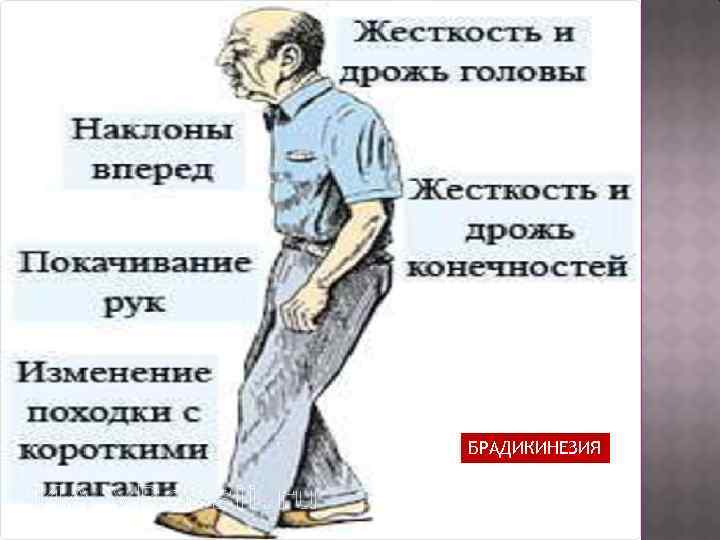 БРАДИКИНЕЗИЯ 