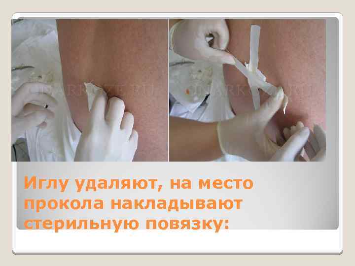 Иглу удаляют, на место прокола накладывают стерильную повязку: 