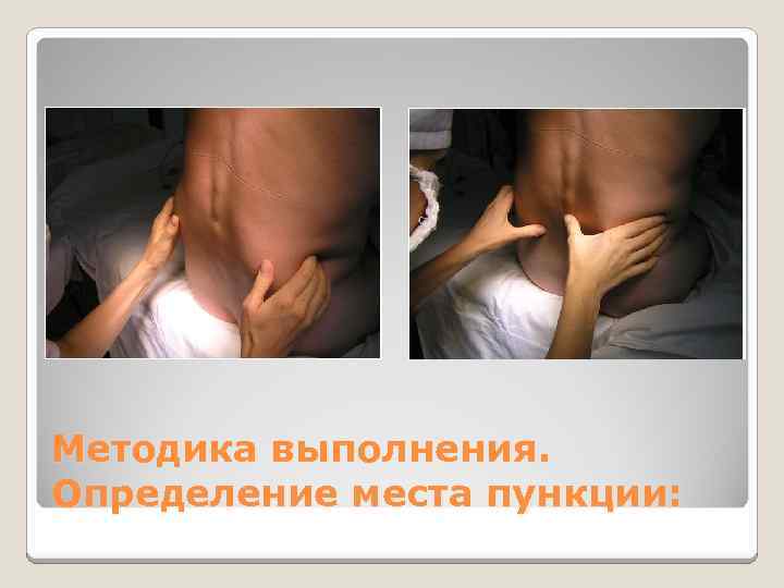 Методика выполнения. Определение места пункции: 