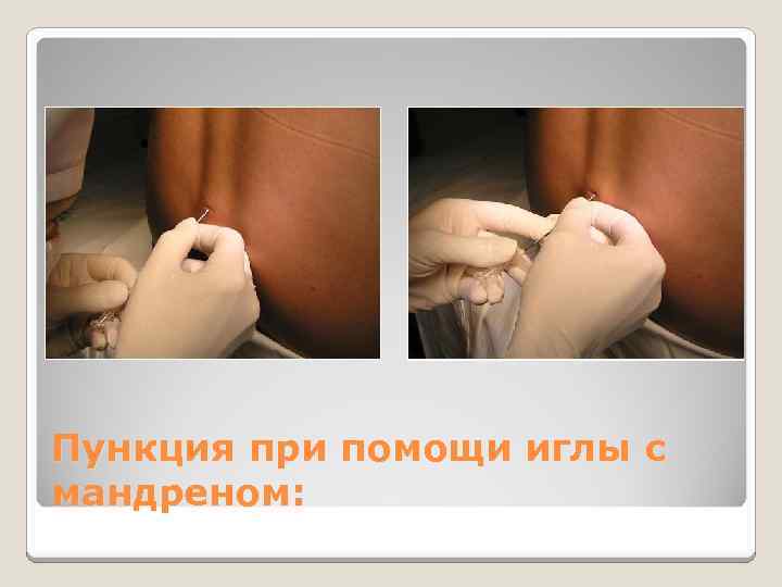Пункция при помощи иглы с мандреном: 