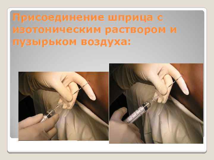 Присоединение шприца с изотоническим раствором и пузырьком воздуха: 