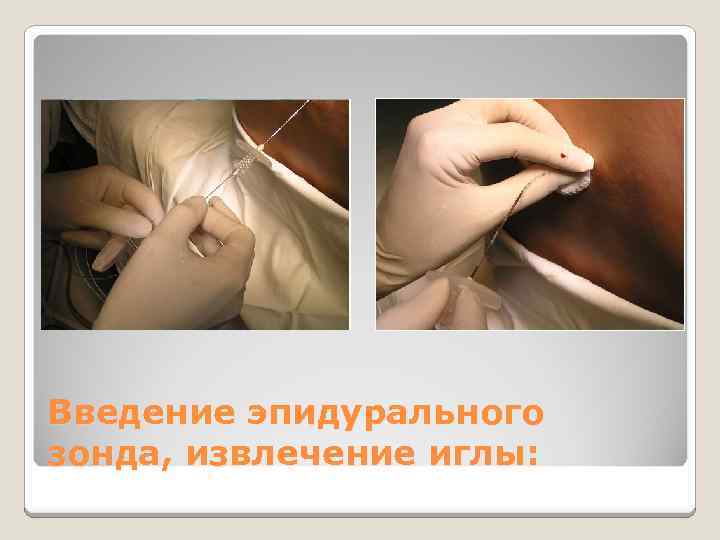 Введение эпидурального зонда, извлечение иглы: 
