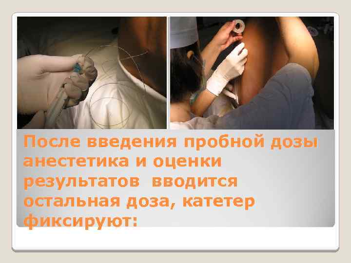 После введения пробной дозы анестетика и оценки результатов вводится остальная доза, катетер фиксируют: 