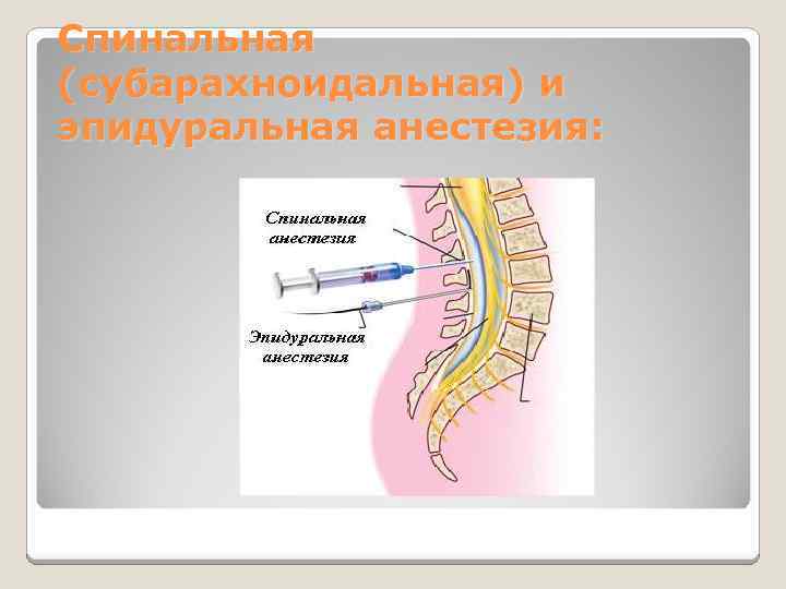 Спинальная (субарахноидальная) и эпидуральная анестезия: 