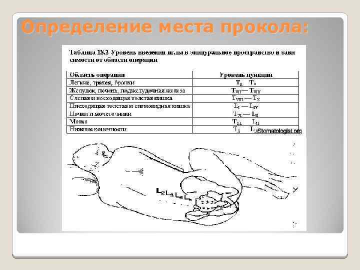 Определение места прокола: 