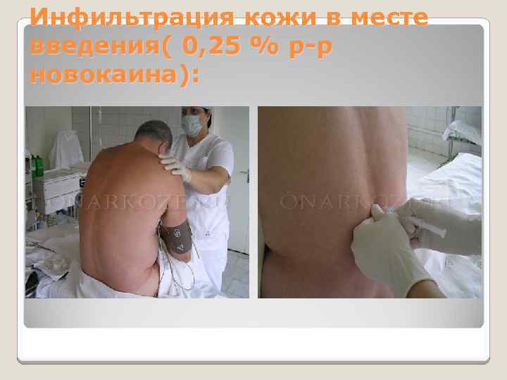 Инфильтрация кожи в месте введения( 0, 25 % р-р новокаина): 