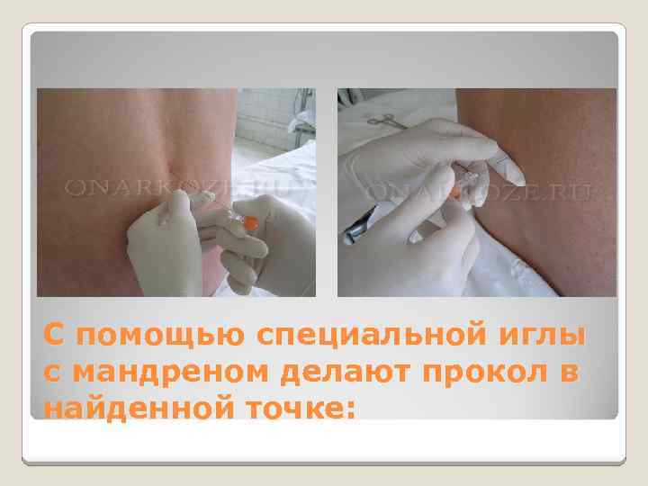 С помощью специальной иглы с мандреном делают прокол в найденной точке: 