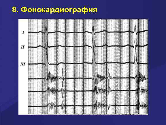 8. Фонокардиография 