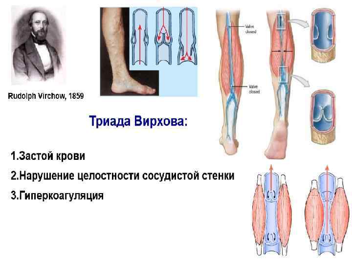 Карта вызова смп тромбофлебит нижней конечности