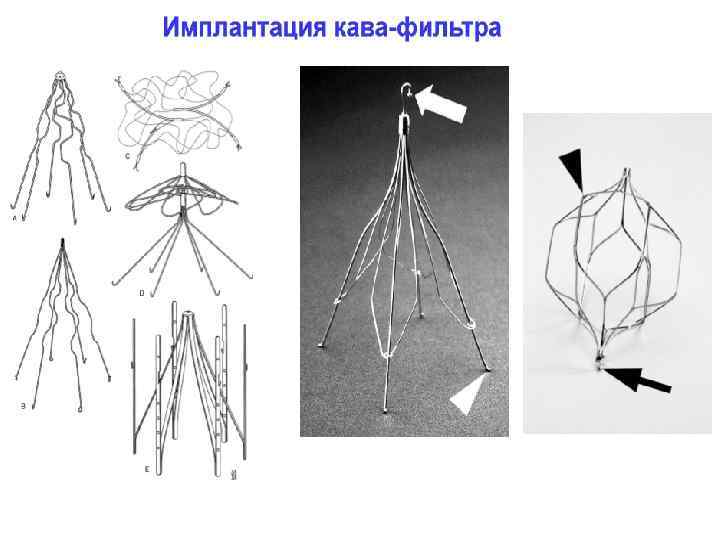 Установка кава фильтра. Имплантация Cava- фильтра. Показания к кава фильтру. Кава фильтр при Тэла.