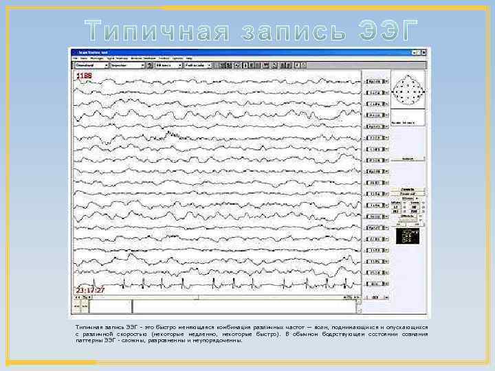 Типичная запись ЭЭГ – это быстро меняющаяся комбинация различных частот — волн, поднимающихся и