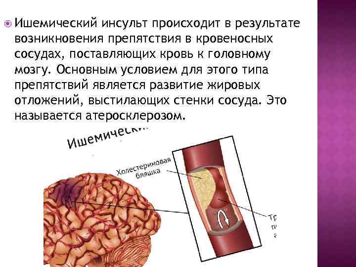  Ишемический инсульт происходит в результате возникновения препятствия в кровеносных сосудах, поставляющих кровь к