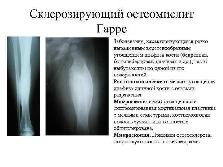 Склерозирующий остеомиелит Гарре Заболевание, характеризующееся резко выраженным веретенообразным утолщением диафиза кости (бедренная, большеберцовая, плечевая