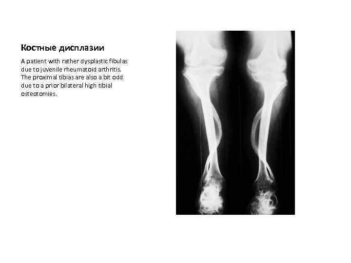 Костные дисплазии A patient with rather dysplastic fibulas due to juvenile rheumatoid arthritis. The