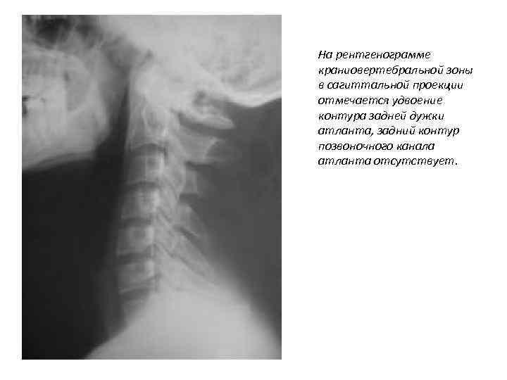 На рентгенограмме краниовертебральной зоны в сагиттальной проекции отмечается удвоение контура задней дужки атланта, задний