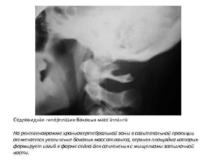 Седловидная гиперплазия боковых масс атланта На рентгенограмме краниовертебральной зоны в сагиттальной проекции отмечается увеличение