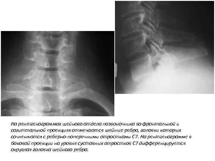 На рентгенограммах шейного отдела позвоночника во фронтальной и сагиттальной проекциях отмечаются шейные ребра, головки