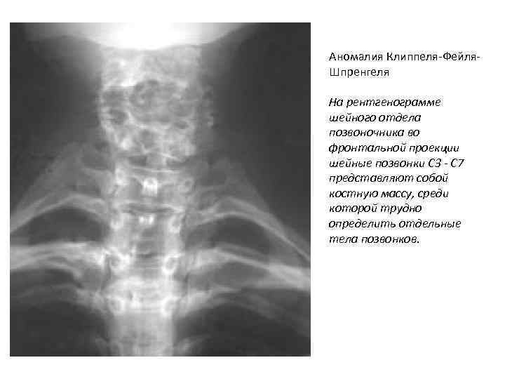 Аномалия Клиппеля-Фейля. Шпренгеля На рентгенограмме шейного отдела позвоночника во фронтальной проекции шейные позвонки С