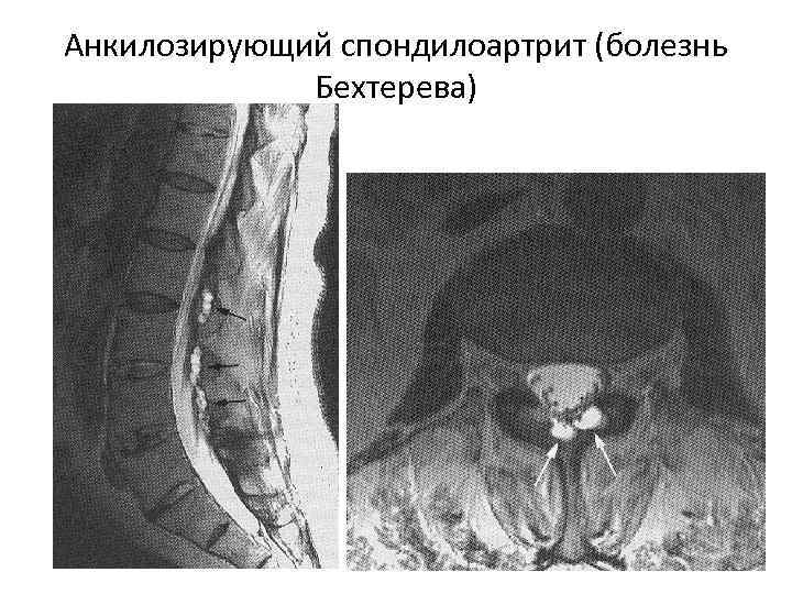 Анкилозирующий спондилоартрит (болезнь Бехтерева) 
