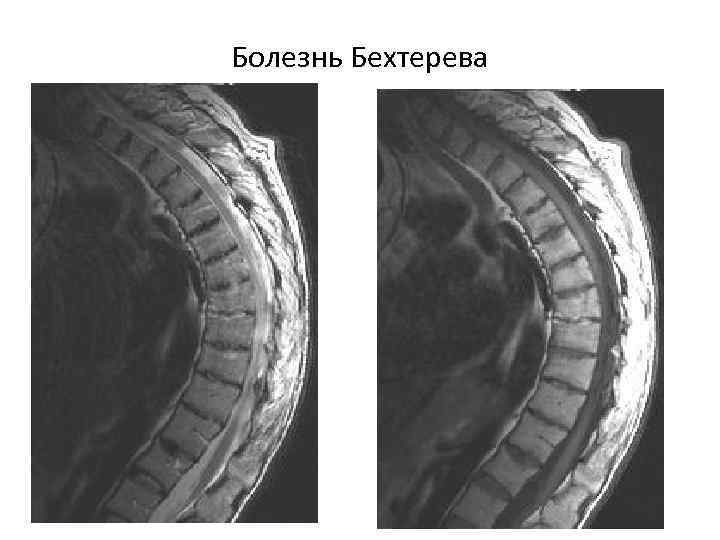 Болезнь Бехтерева 