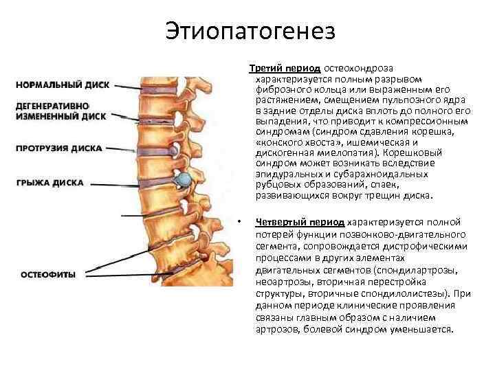 Этиопатогенез Третий период остеохондроза характеризуется полным разрывом фиброзного кольца или выраженным его растяжением, смещением