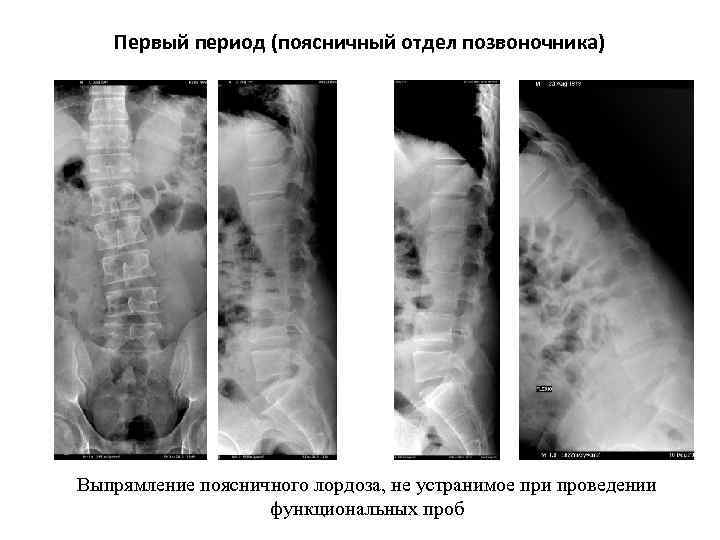 Первый период (поясничный отдел позвоночника) Выпрямление поясничного лордоза, не устранимое при проведении функциональных проб