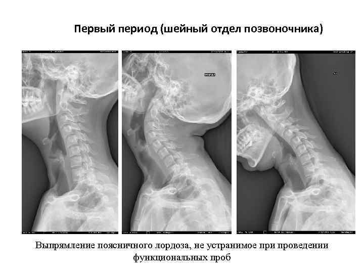 Первый период (шейный отдел позвоночника) Выпрямление поясничного лордоза, не устранимое при проведении функциональных проб