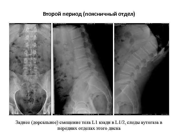 Второй период (поясничный отдел) Заднее (дорсальное) смещение тела L 1 кзади в L 1/2,