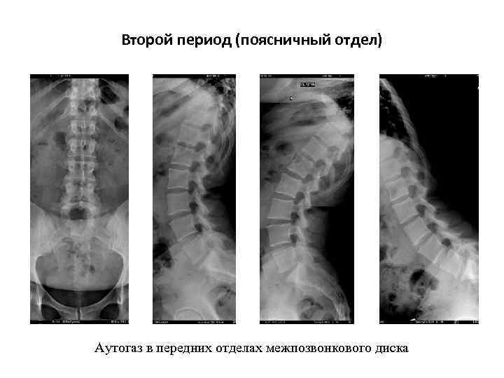 Второй период (поясничный отдел) Аутогаз в передних отделах межпозвонкового диска 
