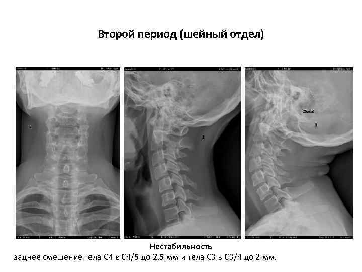 Второй период (шейный отдел) Нестабильность заднее смещение тела С 4 в С 4/5 до