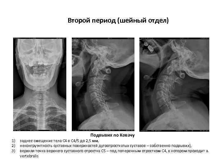 Второй период (шейный отдел) 1) 2) 3) Подвывих по Ковачу заднее смещение тела С