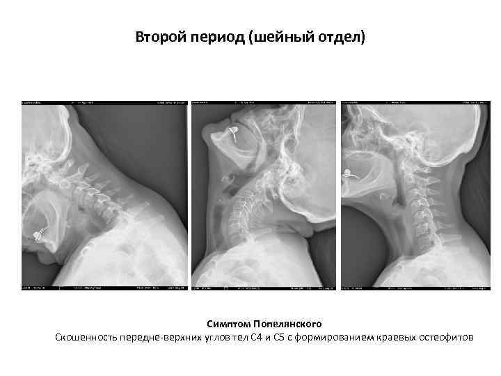 Второй период (шейный отдел) Симптом Попелянского Скошенность передне-верхних углов тел С 4 и С