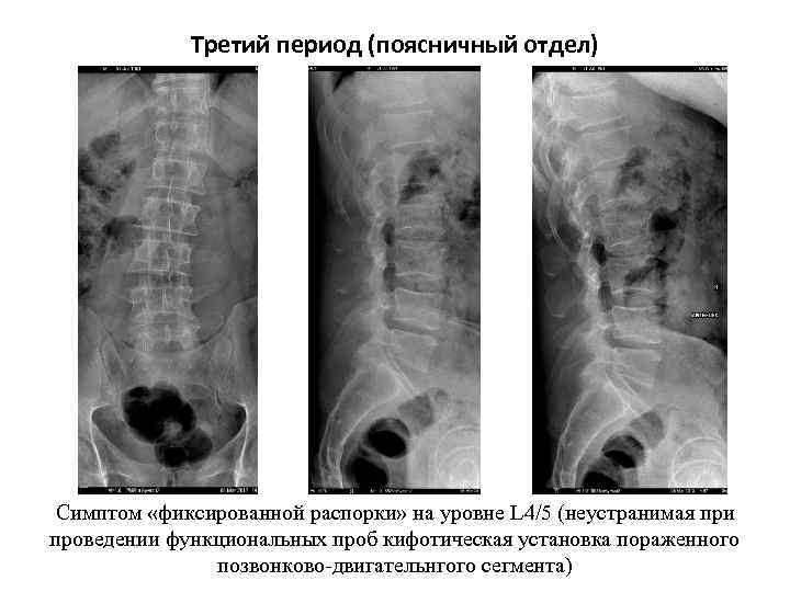 Третий период (поясничный отдел) Симптом «фиксированной распорки» на уровне L 4/5 (неустранимая при проведении