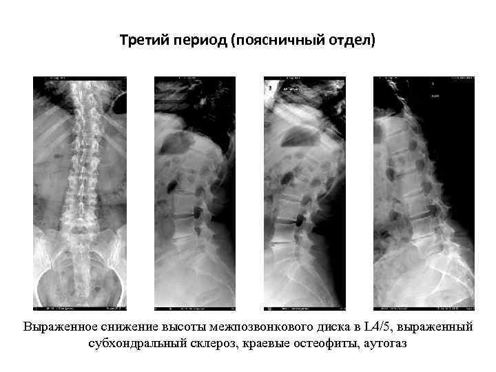 Третий период (поясничный отдел) Выраженное снижение высоты межпозвонкового диска в L 4/5, выраженный субхондральный
