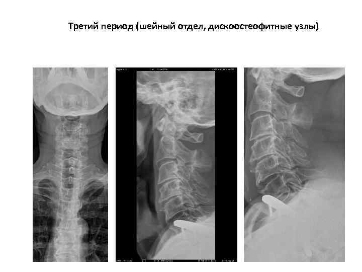 Третий период (шейный отдел, дискоостеофитные узлы) 